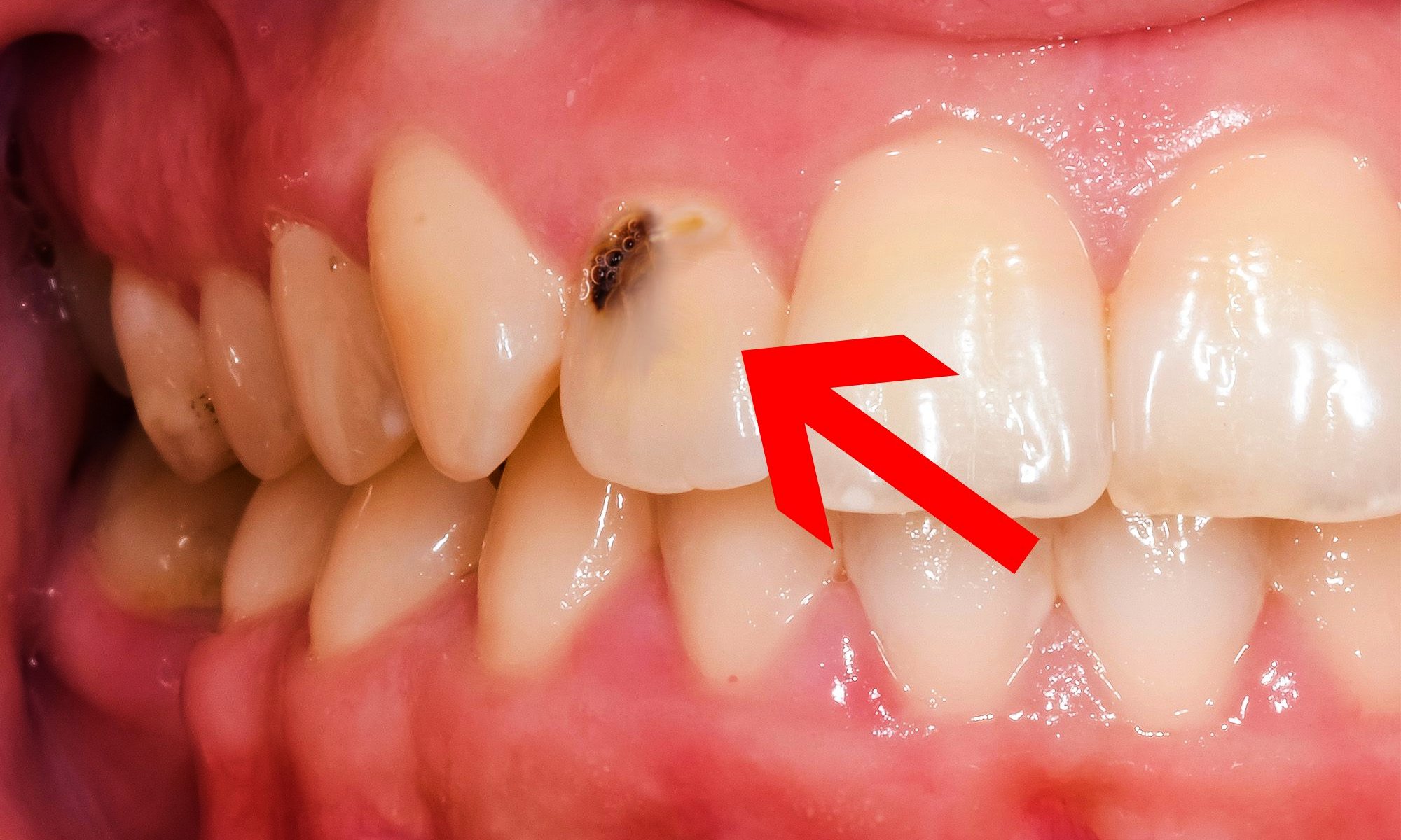 Cavity in front of teeth