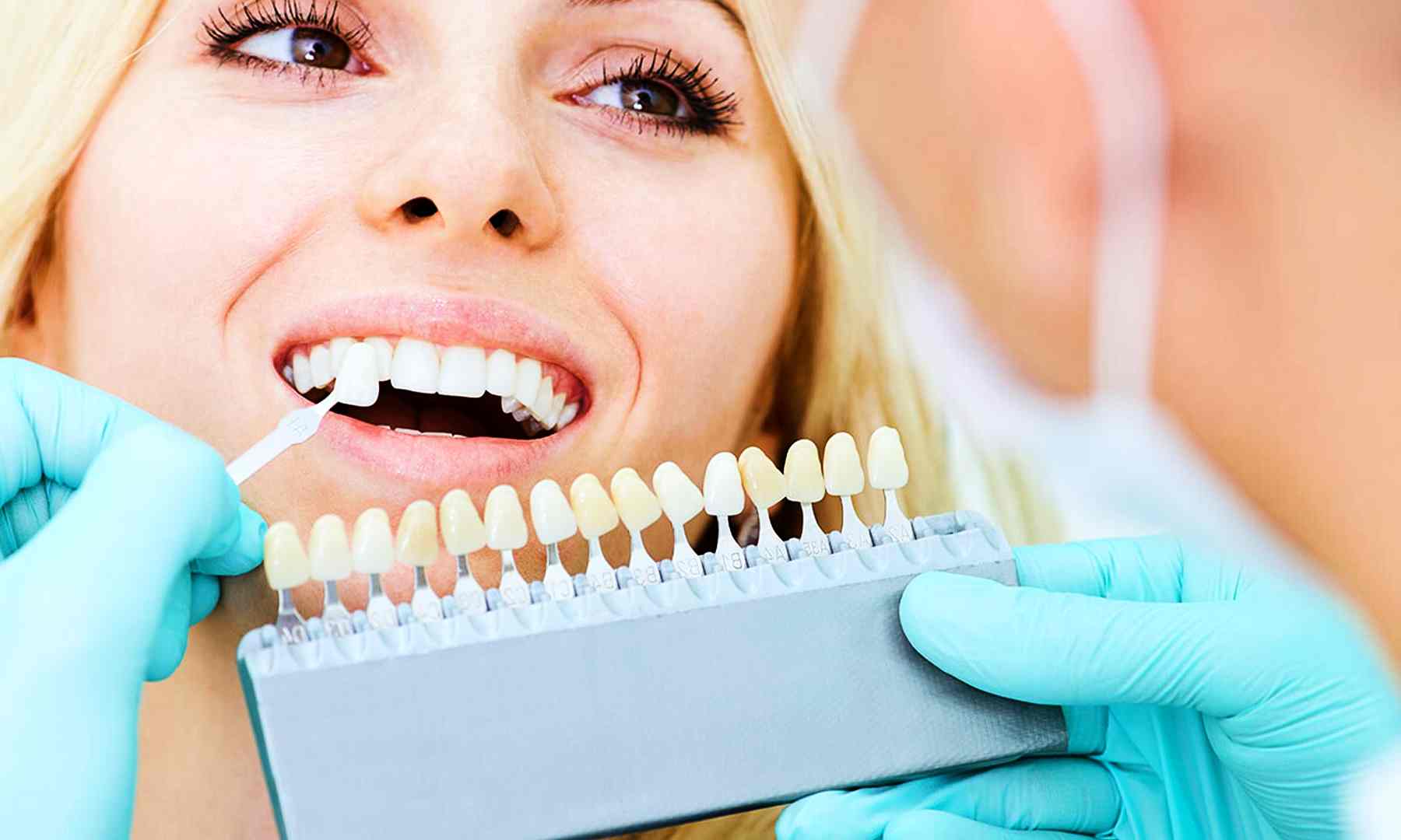 Do You Have to Replace Veneers Every 10 Years_