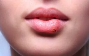 How to Recognize Signs of Herpes After Lip Tattoo