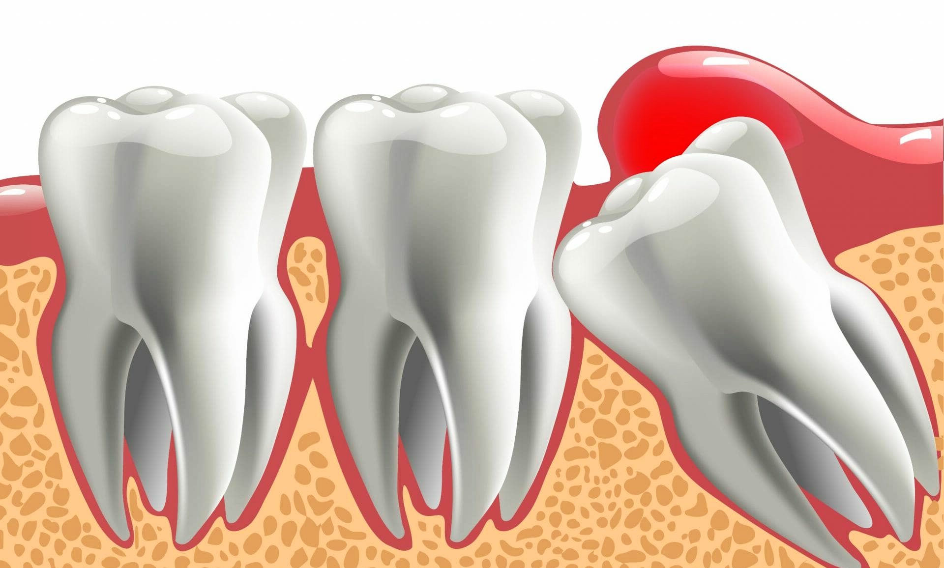 How to get emergency wisdom tooth removal
